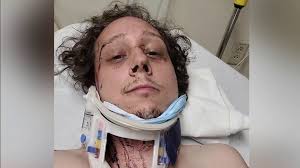 Bicyclist hospitalized after being struck by SUV during high speed chase  discusses incident, injuries