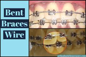 Do it yourself dental impression kit offers teeth aligners, clear retainers, partials, flippers and night guards without a dental office visit. My Braces Wire Gets Bent Why This Happens How To Fix Orthodontic Braces Care