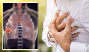 So how do you know if you qualify? Cancer Symptoms The Early Signs Of Lung Cancer You Need To Know Psy Groups Online
