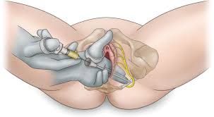 Image result for Pudendal Block