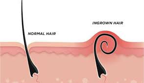 كيف اتخلص نمو الشعر تحت الجلد نمو الشعر بالمقلوب مجلة رجيم