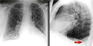 Mri showing bilateral pleural effusion (source). Pleural Effusion Is Bilateral In 70 Of Cases Of Chf When Grepmed