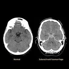 Image result for CT Head