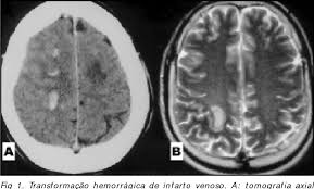 Ze komen in actie als je een wondje hebt. Pdf Trombose De Seio Venoso Cerebral E Trombose Sistemica Associadas A Mutacao Do Gene 20210 Da Protrombina Semantic Scholar