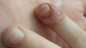 Image result for Akutní zánět nehtového lůžka