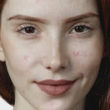 Stop Zit! Anti-Acne Retinol Complex 1 oz