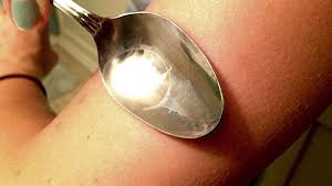 Bug Bite With Black And Blue Ring Around It Pin On Health