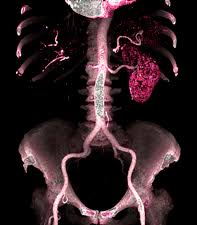 Image result for Renal Infarction