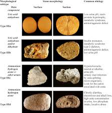 Comprehensive Morpho Constitutional Analysis Of Urinary Stones Improves Etiological Diagnosis And Therapeutic Strategy Of Nephrolithiasis Sciencedirect