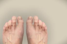 Image result for Hammer toe