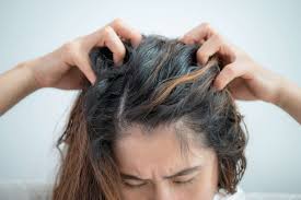 Image result for lice vs dandruff