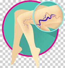 varices png images klipartz varices png images klipartz
