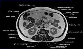 Abdomen Anatomy Mri Abdomen Axial Anatomy Free Cross Sectional Anatomy Ct Scan Abdominal Aorta Human Anatomy Chart