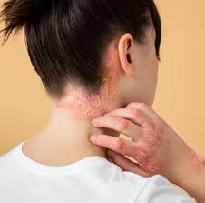 Image result for Seborrheic Dermatitis