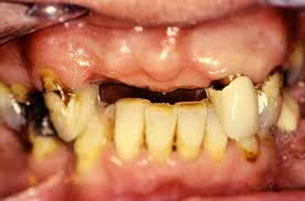 Maybe you would like to learn more about one of these? Bridges The St Peter S Dental Practice