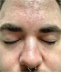 Image result for Seborrheic Dermatitis