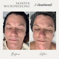 Ashlyn's client after a series of 3 SkinPen Microneedling treatments.  Gorgeous! The results? Brighter, tighter, healthier skin. Look at the  reduction in the appearance of fine lines and improvement of the  hyperpigmentation