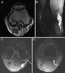 The routine knee mr imaging protocol at the authors' institution (table 1) consists of axial intermediate pd with fat saturation, pd sagittal oblique without fat saturation, pd coronal without fat saturation, intermediate t2 coronal with fat saturation, and intermediate t2 sagittal oblique with fat saturation sequences. High Resolution Mri Of A Peroneal Intraneural Ganglion Cyst Arising From The Knee Joint Illustrative Case In Journal Of Neurosurgery Case Lessons Volume 1 Issue 21 2021