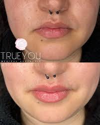 💋 Whether you're looking for subtle hydration or a little extra volume,  lip filler can enhance your features while keeping you 'you'. Ready for a  refresh? 💖✨ • • • Note: Numbing