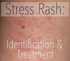 Stress Rash Causes Symptoms Pictures Treatment Hubpages