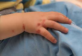 Most toddler mouth sores caused by injuries and burns appear red in the beginning and turn white when healing, so forgotten wounds may look similar to a. 20 Working Home Remedies For Hand Foot Mouth Disease