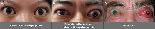 Most cases of hyperthyroidism result from graves' disease, an autoimmune reaction that causes the. Teprotumumab An Insulin Like Growth Factor 1 Receptor Antagonist Antibody In The Treatment Of Active Thyroid Eye Disease A Focus On Proptosis Eye