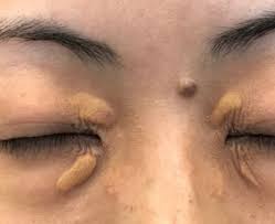 Image result for xantelasma
