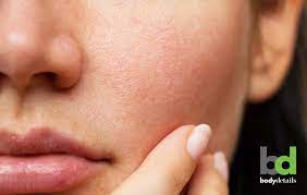 How Effective Are Acne Laser Treatments At Minimizing Pores