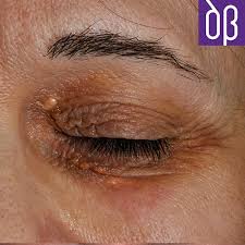 Image result for xantelasma