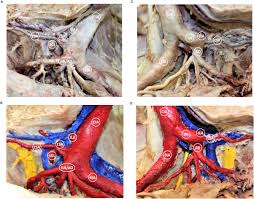 The internal iliac artery divides into two trunks called anterior and posterior. A Missing Posterior Division Of The Internal Iliac Artery Sciencedirect