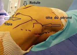 Orthèses plantaire, ongles incarnés, verrues et plus. Syndrome De Compression Du Sciatique Poplite Externe Spe Ou Nerf Peronier