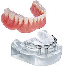 Aujourd'hui, pour avoir une meilleure dentition en apparence, il est possible de choisir de se faire poser une prothèse dentaire fixe ou bien une prothèse dentaire amovible. Bridge Complet Fixe Sur 8 Implants Prothese Amovible Sur 4 Implants