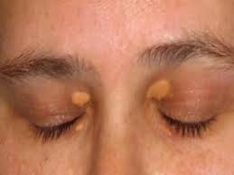 आंखों के आसपास बन रहे हैं कोलेस्ट्रॉल जमा होने के निशान, समस्या दूर करेंगे  ये घरेलू नुस्खे Dyslipidemia treatment: get rid of cholesterol deposit  spots around eyes with these ...