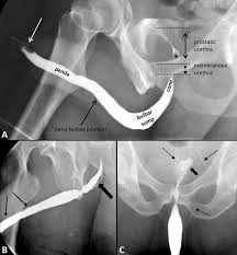 Image result for Retrograde Urethrogram