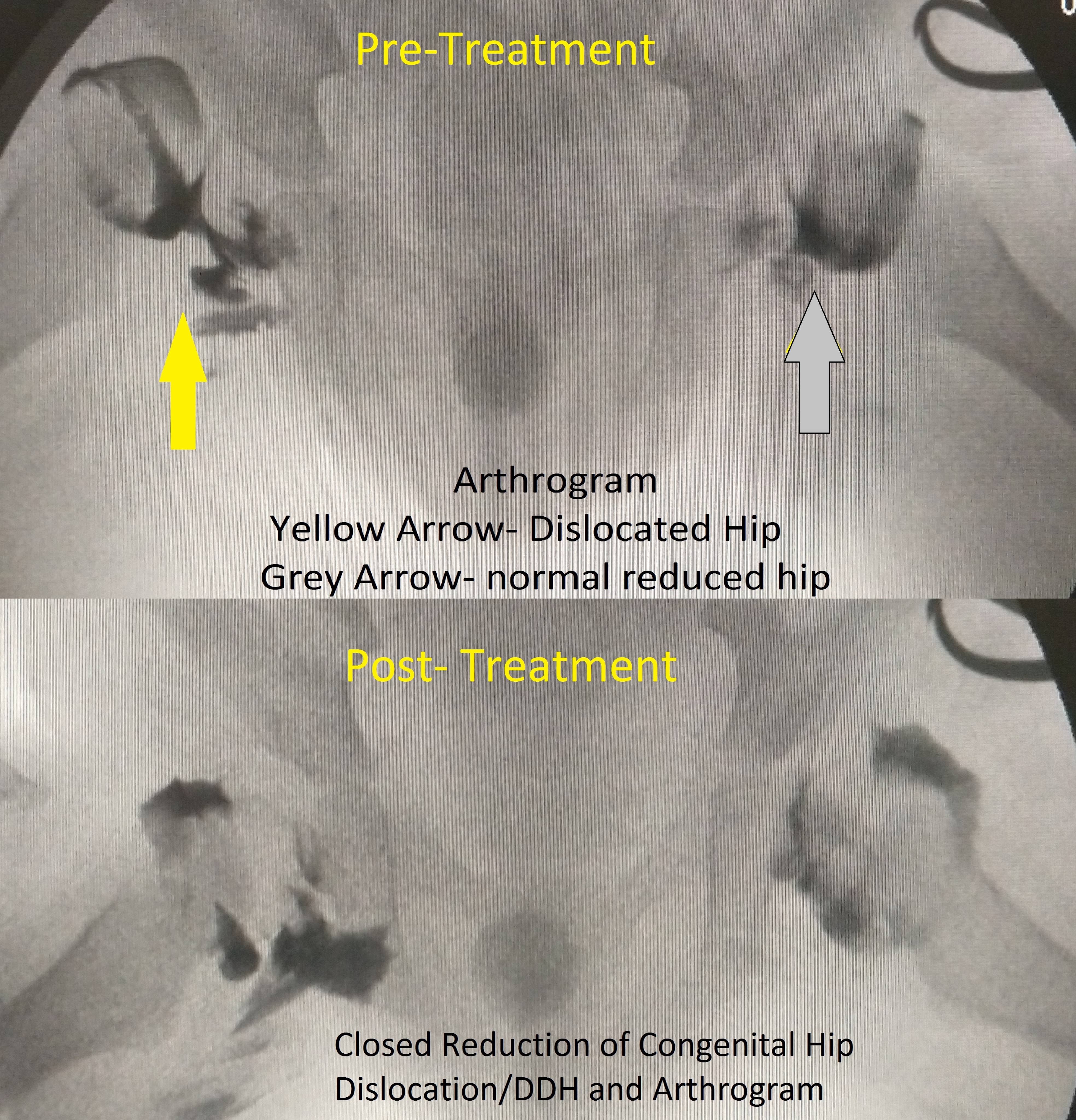 Developmental Dysplasia of Hip (DDH) product image