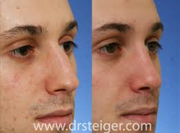 Before and after pictures show a straighter line after dermal filler has been injected. Rhinoplasty Before And After Photos