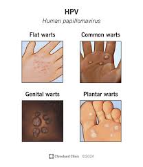 Image result for genital warts