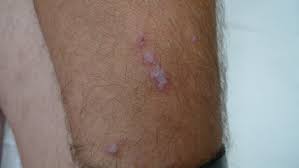 From least to most common. Acd A Z Of Skin Lichen Planus