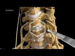 C5 C6 C7 Anterior Cervical Discectomy With Fusion Youtube Cervical Fusion Surgery