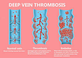 Pulmonary Embolism Healthdirect