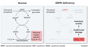 Image result for G6PD Deficiency