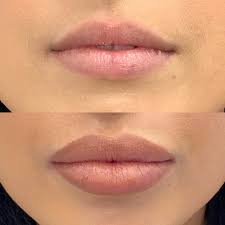 What are the best lip injections? Lip Fillers And Lip Augmentation Adam J Oppenheimer Md