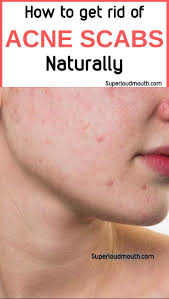 40 Best Ways To Get Rid Of Acne Scabs Overnight Diy Home Remedies How To Get Rid Of Acne Acne Scab How To Get Rid Of Pimples