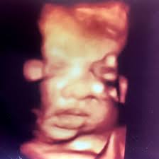 Aşağıdaki aracımızı kullanarak son adet tarihini girin, size kaç haftalık hamile olduğunuzu söyleyelim. Hafta Hafta Gebelik Jin Op Dr Yesim Yercok