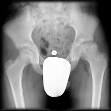Perthes disease (lcpd) are based on subjective measures. Perthes Disease Radiology Reference Article Radiopaedia Org