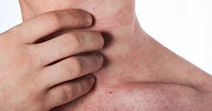 .among patients with skin rash following amoxicillin treatment within infectious mononucleosis. Symptoms Of Mono Rash Infectious Mononucleosis Causes Treatment