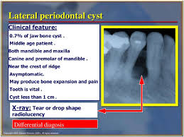 Jaw Bone Cyst