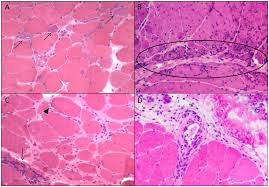 Image result for Myopathy