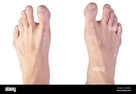 Image result for Hallux Varus