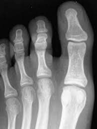 Image result for Interphalangeal Dislocation